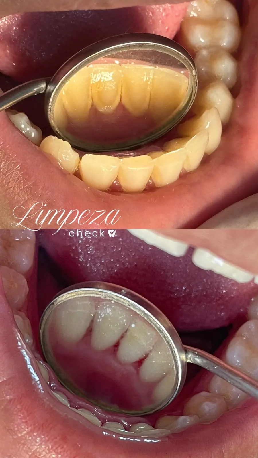 Profilaxia dental
